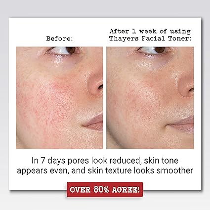Thayers Witch Hazel Holiday Edition